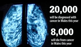 Lung Cancer in West Wales – What you need to know / Canser yr Ysgyfaint yng Ngorllewin Cymru – Yr hyn sydd angen i chi ei wybod Lung Cancer X Ray