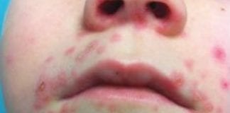 HEALTH NEWS – HOW TO STOP HAND, FOOT & MOUTH DISEASE SPREADING Screenshot 20181026 135824