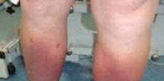 Bwrdd Iechyd Prifysgol Hywel Dda yn ymestyn ei wasanaeth asesiadau digidol i gleifion Lymphoedema download 2021 03 26T142941.368