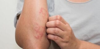 Children’s eczema flared up in lockdown – and the skin microbiome is key bf02bc45 333