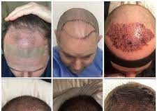 REVEALED: Hair transplant is the most searched for cosmetic surgery in the UK of 2021 download 1