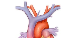 Prosiect Calonnau Iach yn cael ei lansio yn Sir Gaerfyrddin Myocardial Infarction An Unavoidable Risk
