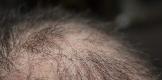 Hair Loss and Mental Health: How They’re Linked and What Are The Ways to Treat It hair g2f8899eda 1920