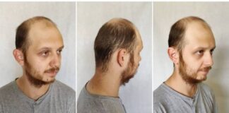 Young men turning to hair transplants at the first sign of hair loss c625fee2bb080f5336760df6c118f9b0 min