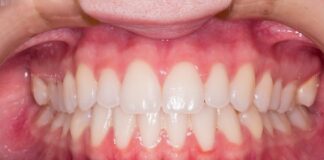 Turkey Teeth: Experts debunk medical terms patients still get WRONG teeth g018d0b7f0 1280 min
