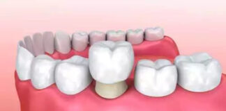 The Science of Confidence: Cosmetic Dentistry and Self-Assurance Dental crown scaled