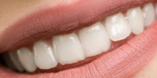 ‘Veneer Techs’, Teeth Discoloration & Natural Teeth Whitening – Explained by Bandon Dental smile