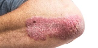 In Psoriasis Awareness Month: expert on how to best cope with a condition affecting millions. 800px Psoriasis on elbow