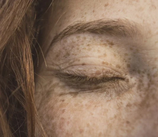 Five Ways To Combat Wrinkles Without Using Botox beauty wrinkles freckles