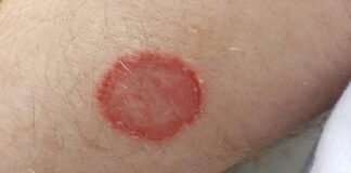 Getting back into fitness this January? Expert shares key tips to stay germ free in the gym 1440px Dermatophytosis 20190815 02ASD