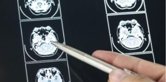 Brain Bleed and Other Injuries That Are Common in Car Accidents car accident