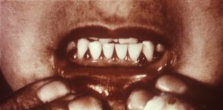 Dentist Warns of Scurvy’s Impact on Oral Health Amid Welsh Outbreak 1197px Scorbutic gums