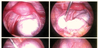 Launch of Endometriosis Action Month (March 2025 Endometriosis
