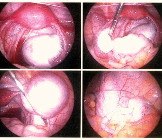 Launch of Endometriosis Action Month (March 2025 Endometriosis