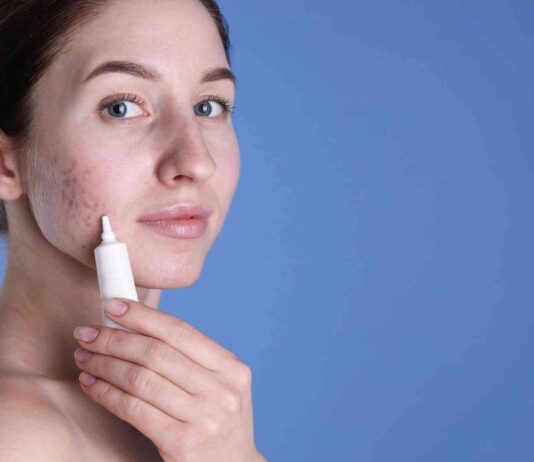 Achieving luminous skin: a holistic approach to imperfection-free radiance youngwomanwithacneproblemapplyingcosmeticproductontoherskin wp