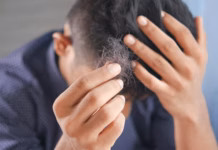 Hair Loss After Rapid Weight Loss: Pharmacist Explains Why It Happens And How To Reduce The Risk photo 1633179963355 44f57f194d54