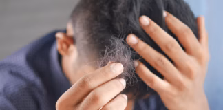 Hair Loss After Rapid Weight Loss: Pharmacist Explains Why It Happens And How To Reduce The Risk photo 1633179963355 44f57f194d54