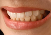 Are veneers worth it? Benefits, costs, and what to expect usushiorei asian smile 3672997
