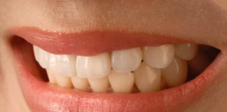 Are veneers worth it? Benefits, costs, and what to expect usushiorei asian smile 3672997